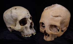 Cut marks on 4,000-yr-old skulls show ancient Egyptians tried to treat cancer