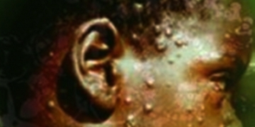 BREAKING NEWS: WHO declares global health emergency over Mpox outbreak