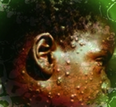 BREAKING NEWS: WHO declares global health emergency over Mpox outbreak