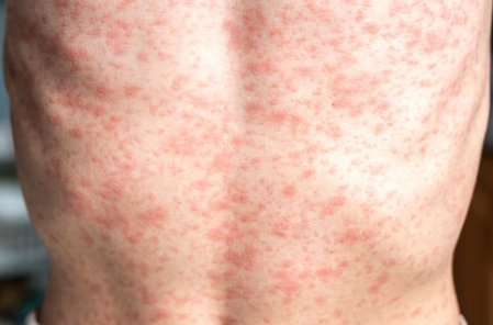 Mongolia’s total number of confirmed measles cases exceeds 500