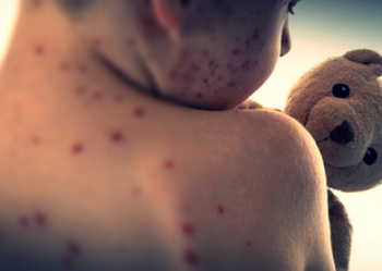 US reports over 800 measles cases in 2025
