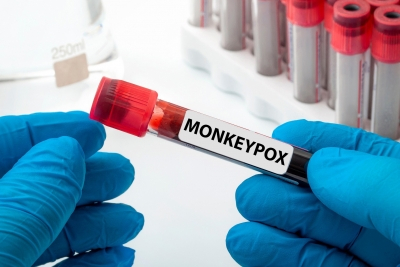 mpox virus circulating in West Africa long before 2022 global outbreak: Study