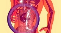 Fatty liver in pregnancy may increase risk of preterm birth
