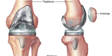 Diabetes may raise infection, blood clot risk post knee replacement surgery: Study