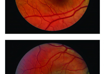 Surgical implant can slow down vision loss caused by blinding eye disease: Study