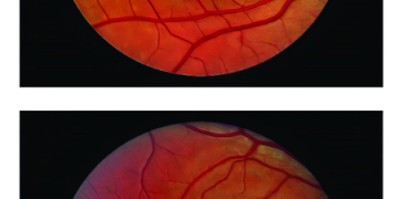 Surgical implant can slow down vision loss caused by blinding eye disease: Study