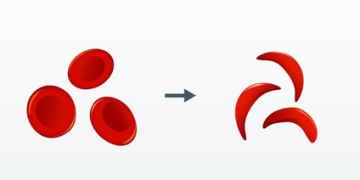 Sickle Cell elimination mission tackling genetic disorder to ensure equity, dignity: PMO