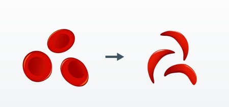 Sickle Cell elimination mission tackling genetic disorder to ensure equity, dignity: PMO
