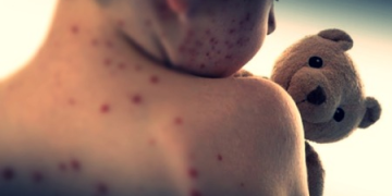 US reports record measles cases since 1992