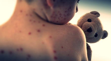 US reports record measles cases since 1992