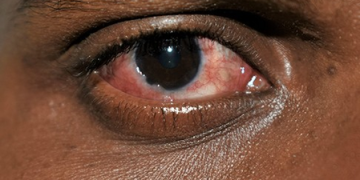 Conjunctivitis cases rise in Chennai; doctors stress hygiene, early treatment