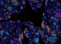Australian study identifies early blood marker for lung cancer risk