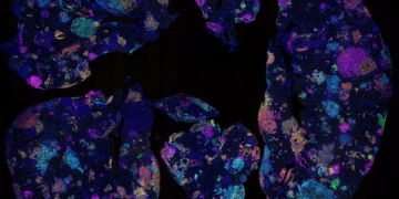 Australian study identifies early blood marker for lung cancer risk
