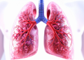 lung cancer