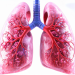 lung cancer