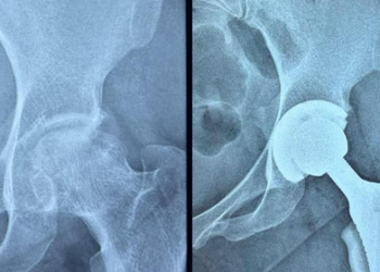 Gujarat: Ahmedabad Civil Hospital performs high-risk hip replacement on woman with serious blood disorder