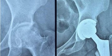 Gujarat: Ahmedabad Civil Hospital performs high-risk hip replacement on woman with serious blood disorder